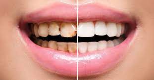 Types Of Dental Veneers 