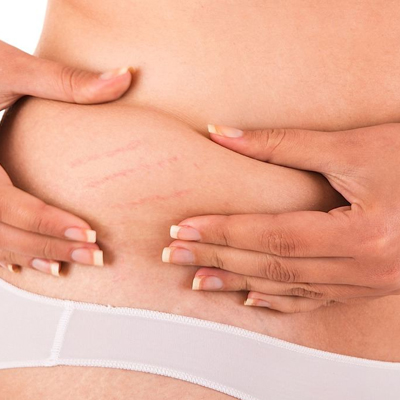Where Can I Get The Best Tummy Tuck Surgery in Ahmedabad?