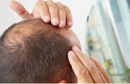 Male Pattern Baldness Stages