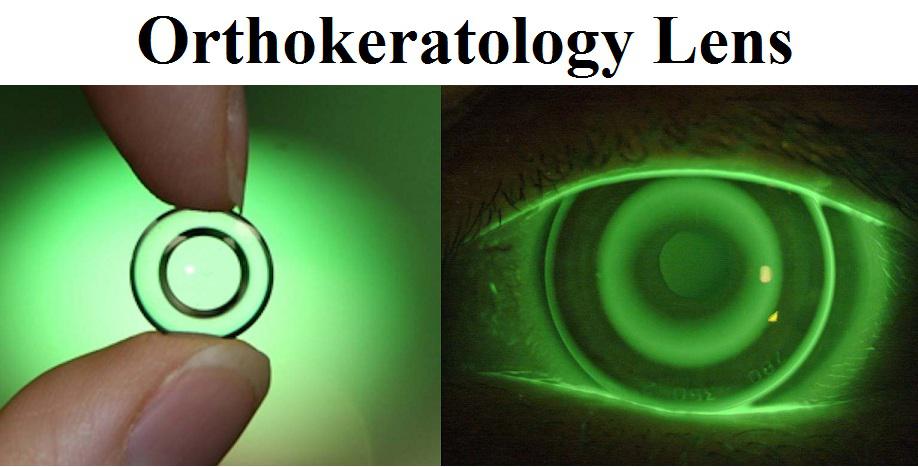 Orthokeratology Market 2022 Size, Dynamics & Forecast Report to 2028
