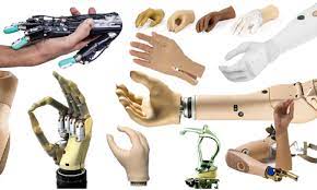 Upper Limb Prosthetics Market 2022 Major Key Players and Industry Analysis Till 2028