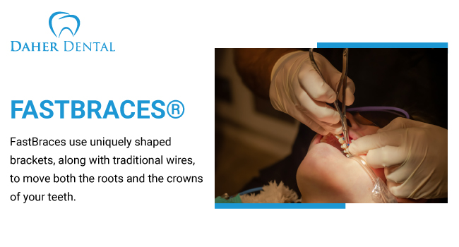 Explaining Fast Braces And How They Work - My London Dentist