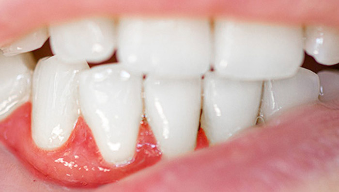 Guide to gum recession