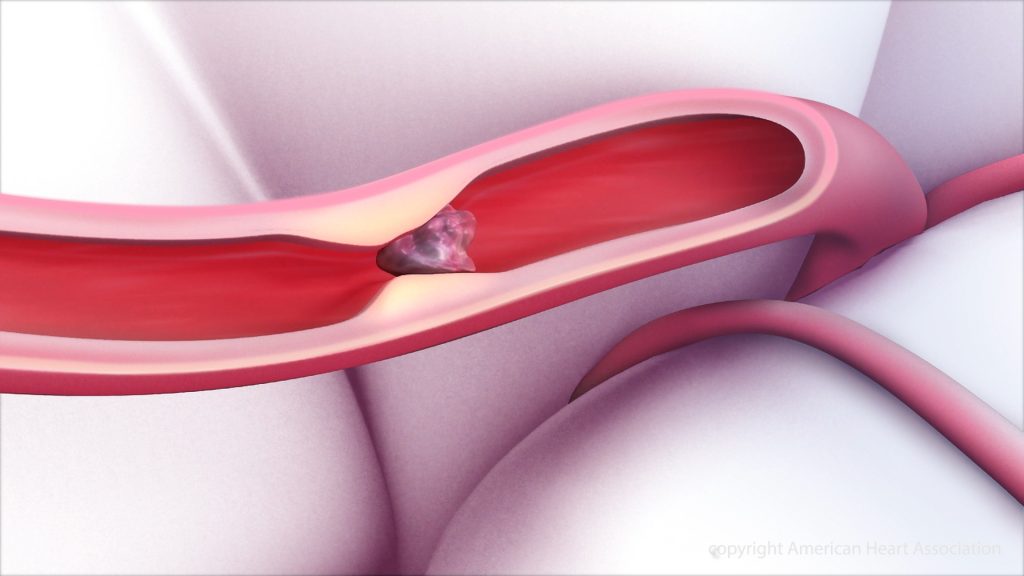 Microvascular Blood Clot Retrieval Devices Market are Set to Witness Significant Growth Owing to Increasing Number of Vascular Surgeries