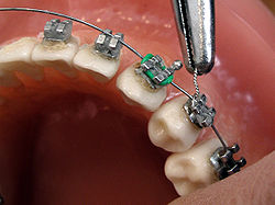 Orthodontics Market (2023-2030): Opportunities in Emerging Economies