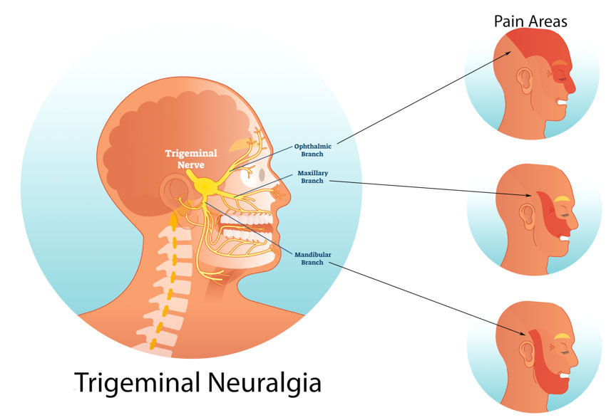 Trigeminal Neuralgia Treatment Market Global Trends, Market Share, Industry Size, Growth, Opportunities and Market Forecast 2022-2028