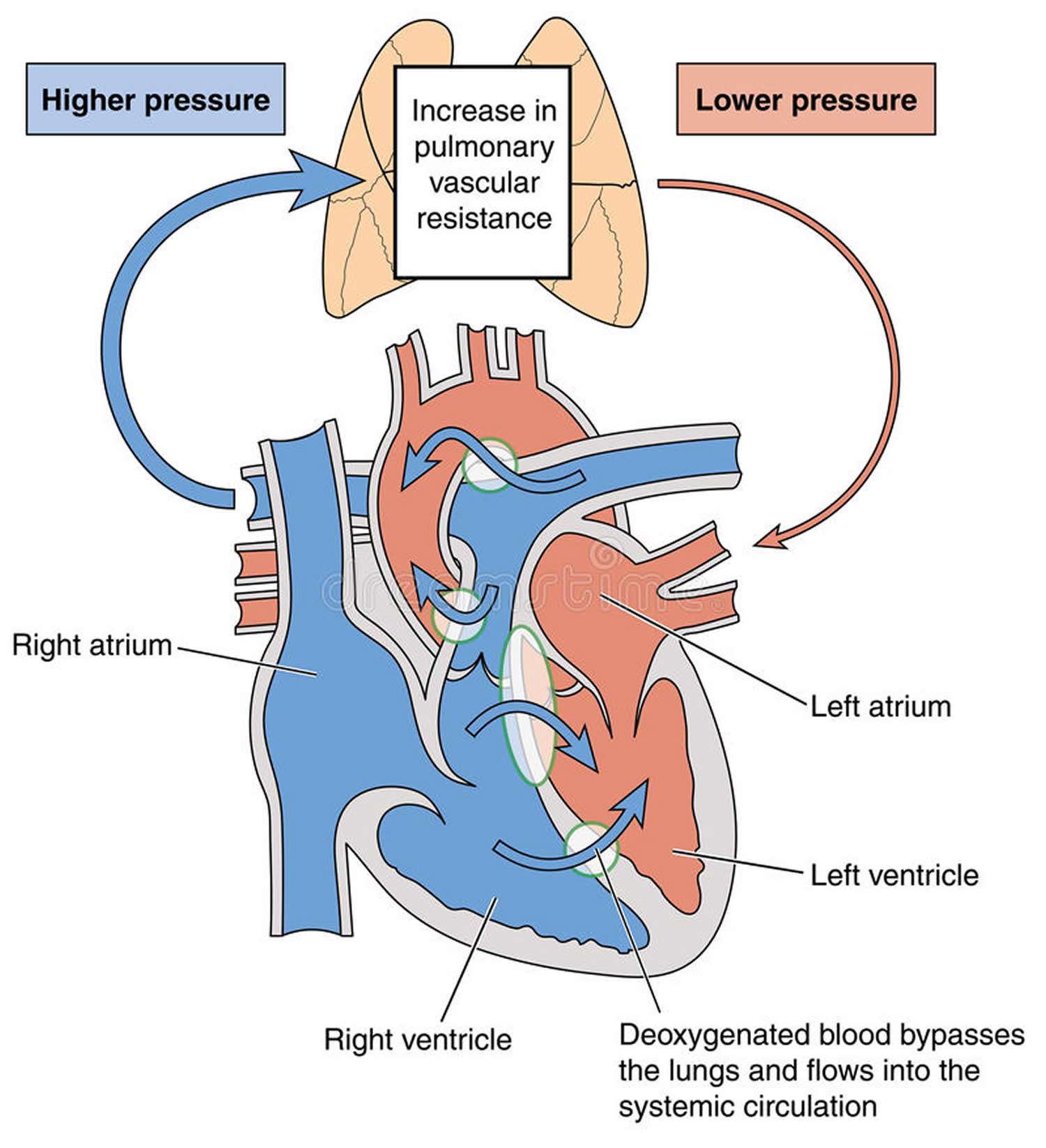 Eisenmenger Syndrome Treatment Is Determined By A Patient's Symptoms And Condition