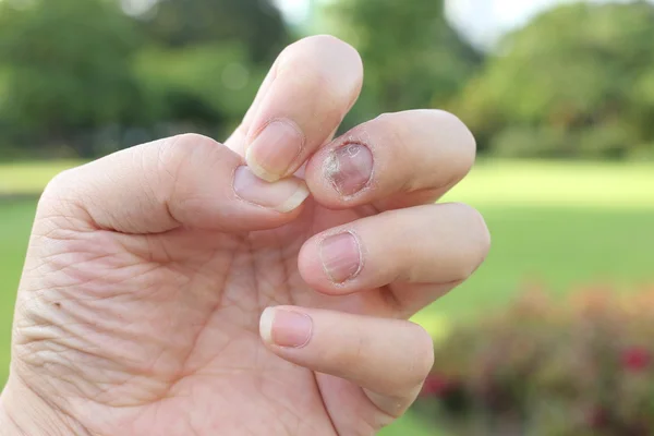 Onychomycosis Treatment Aims To Eradicate The Fungus And Promote Healthy Nail Growth