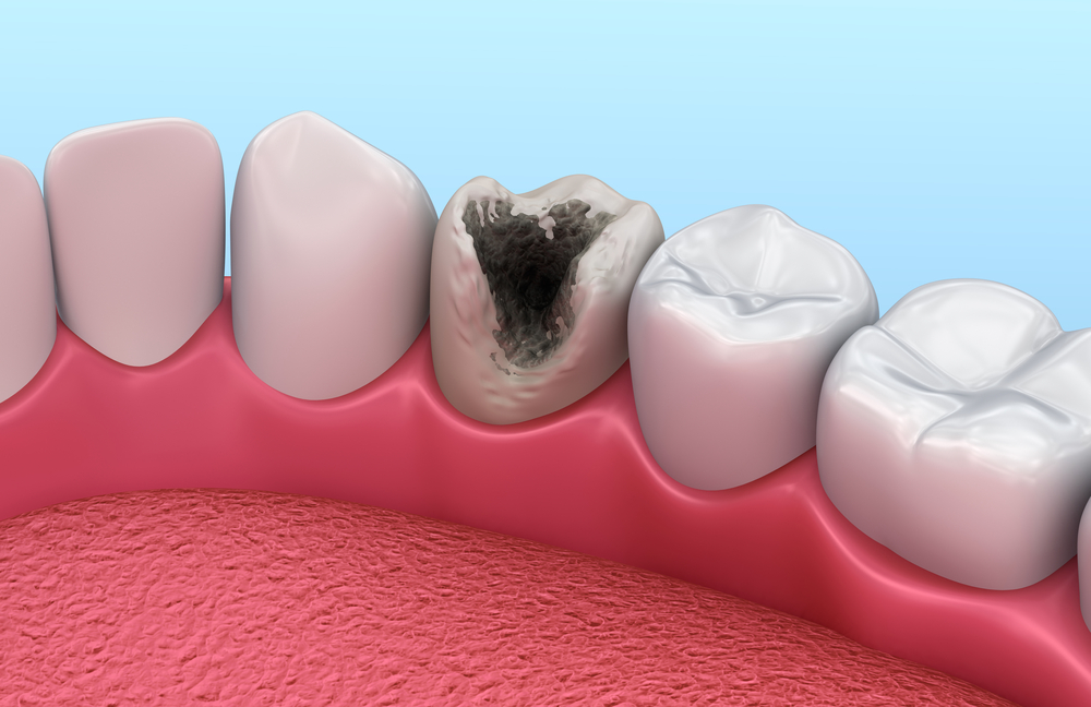 Dental Caries Treatment Market is in early adoption trends by preventive care