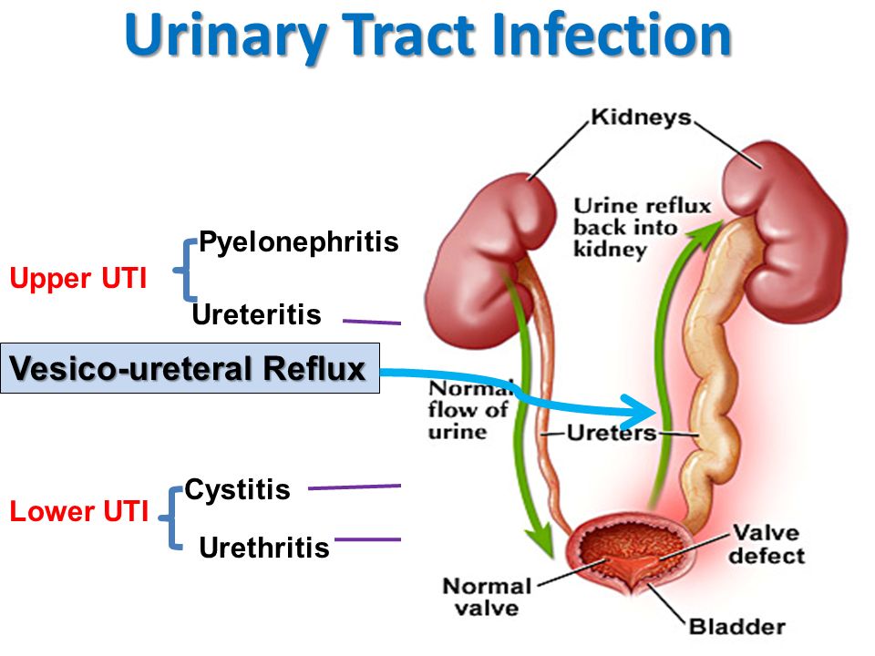 How Long Should You Take Urinary Tract Infections Treatment?