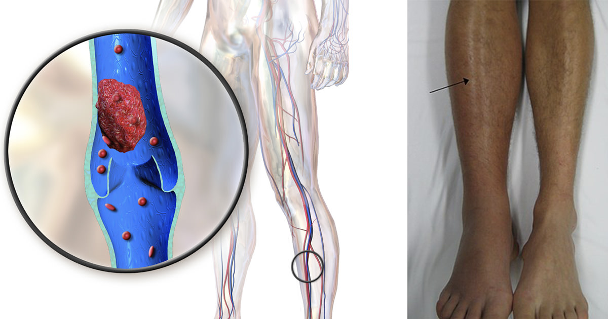 Venous Thromboembolism (VTE) Occurs When Thrombi Form In A Deep Vein Caused By Blood Clots