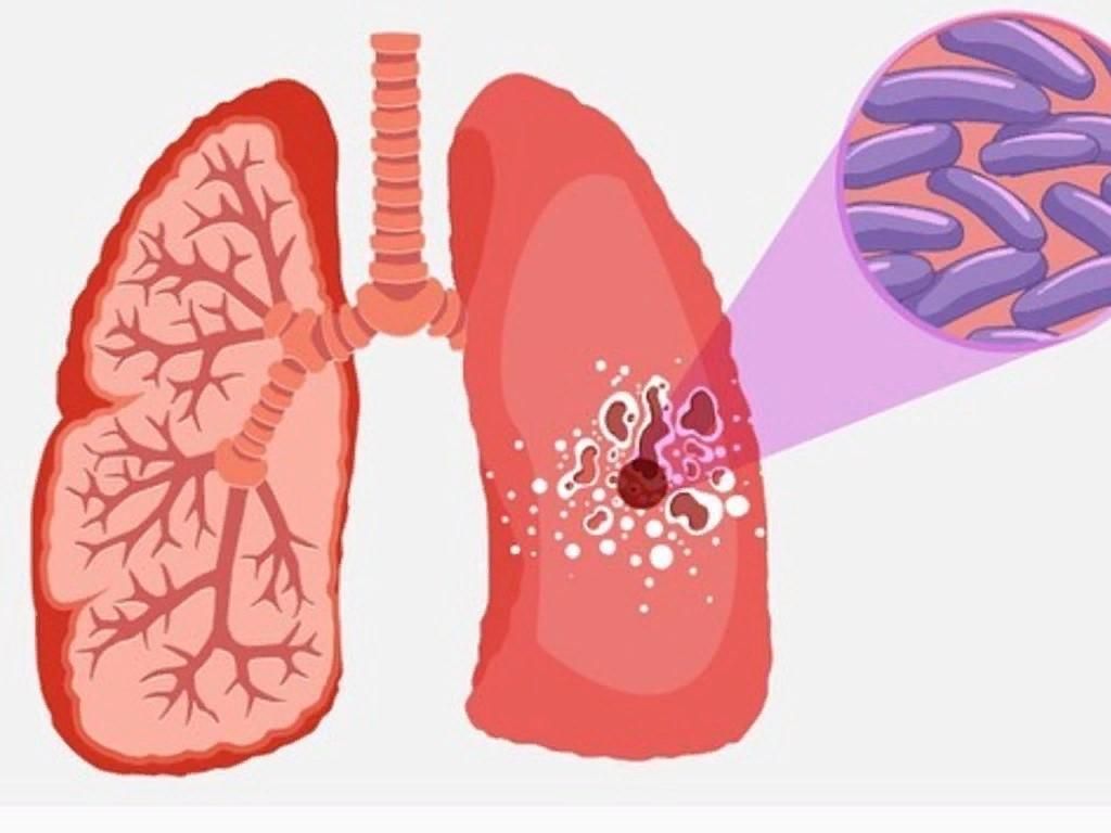 An Overview of Tuberculosis Vaccine and Its Effectiveness Against Tuberculosis