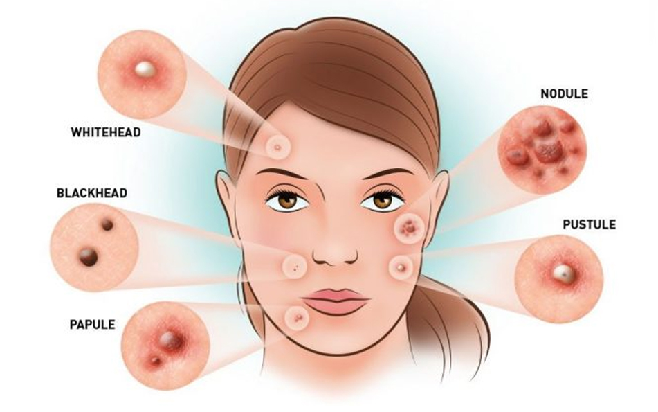 What Are the Issues Related to Acne Vulgaris Treatment?