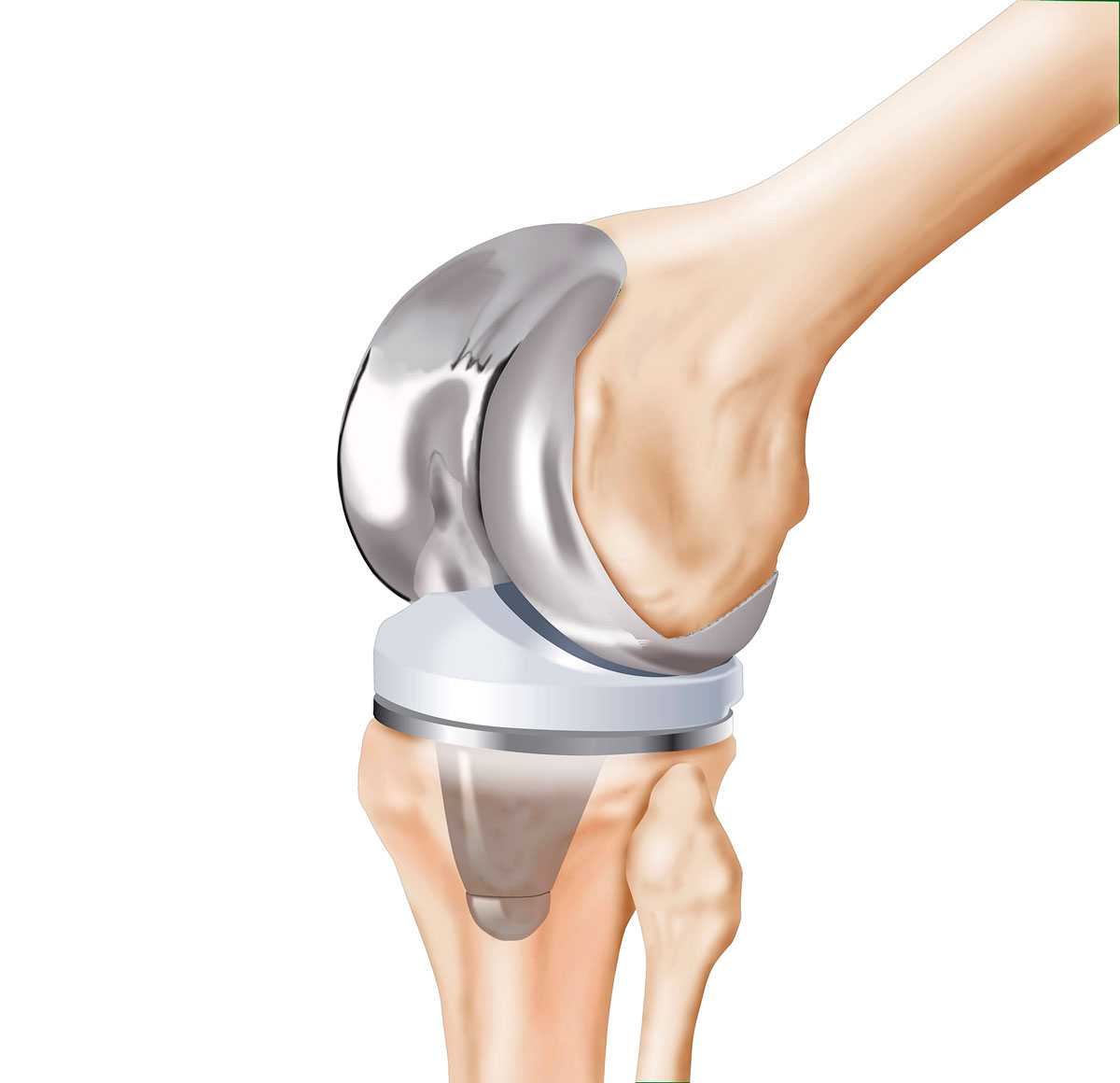 Total Knee Arthroplasty Market to Grow at Highest Pace Owing to Increasing Geriatric Population