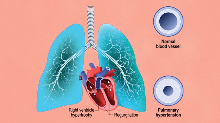 Symptoms And Progression Of Pulmonary Arterial Hypertension Are Improved By Pulmonary Arterial Hypertension Drug