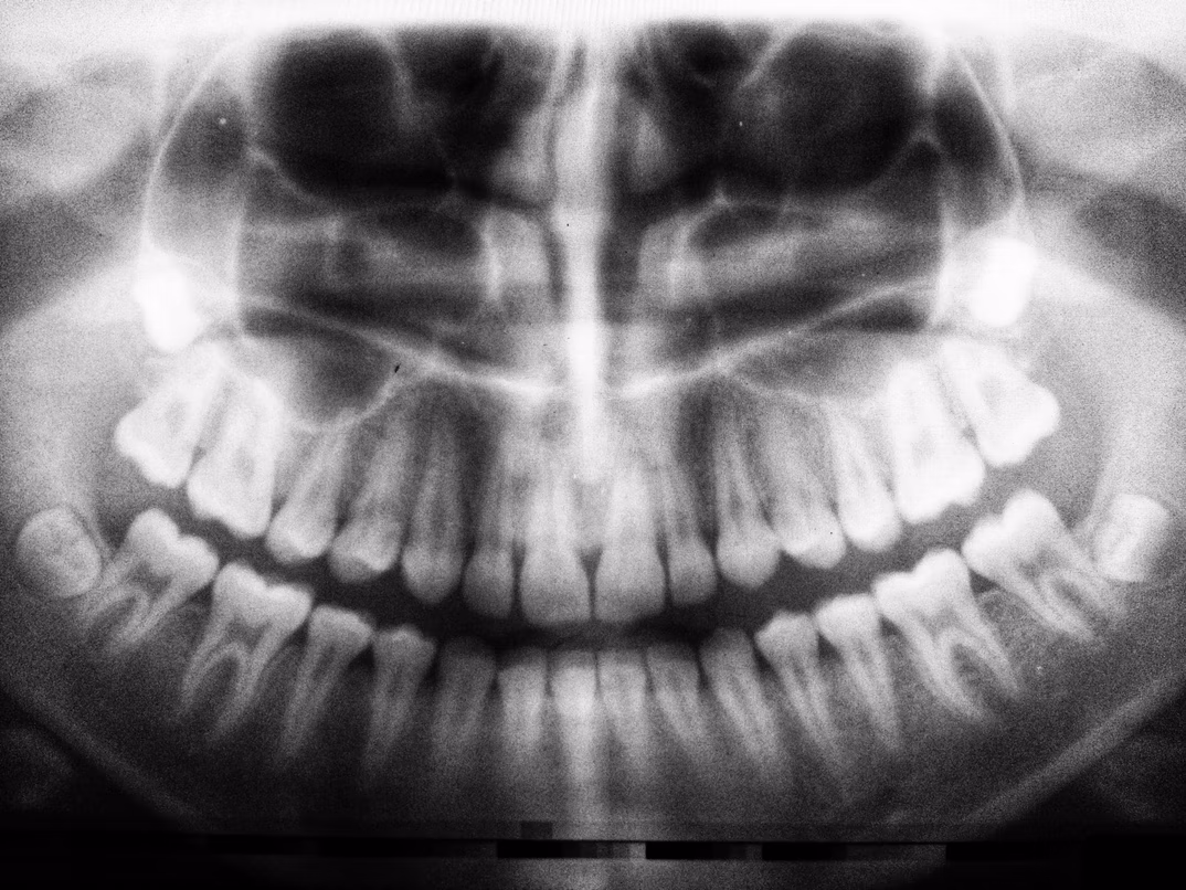 How to Respond to Dental Emergencies During Travel?