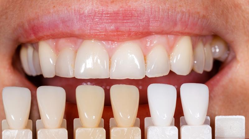 Are Veneers Right for You - Cosmetic Dentistry