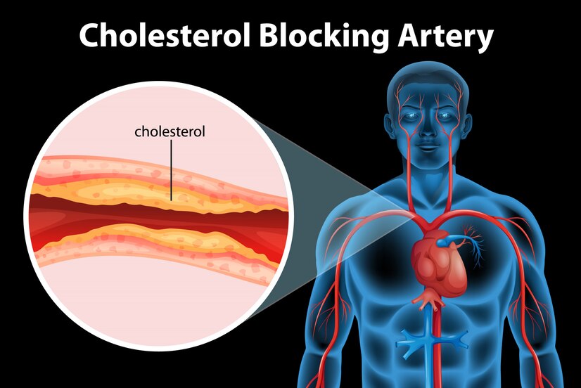 7 Causes of High Cholesterol