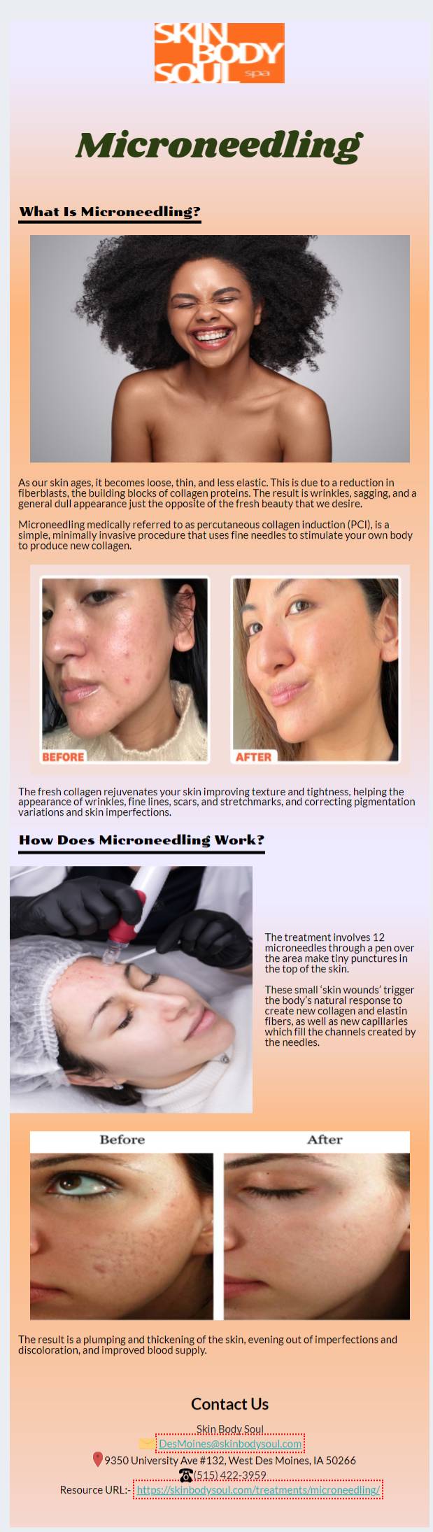 How Does Microneedling Work?