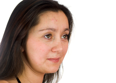 How Microneedling Can Solve Your Skin Woes