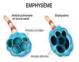 Global Emphysema Treatment Market 2022: COVID-19 Impact Analysis and Industry Forecast Report, 2028