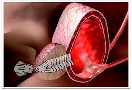 Global Prostate Stents Market 2022 - Top Key Players Analysis Report Till 2028