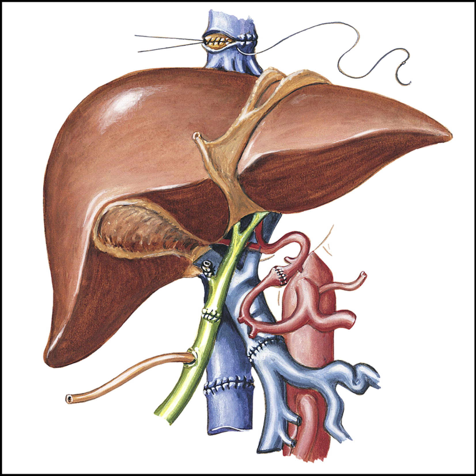 Liver Transplantation Market Strategy, Segmentation Analysis and Forecast to 2028