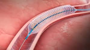 Global Biodegradable Medical Polymer Market 2018 - Evonik, Corbion, DSM, Mitsui Chemicals, PCAS, Poly-Med