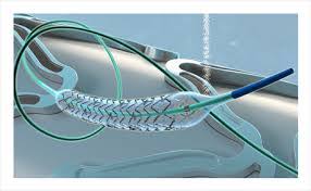 Global Neurovascular Devices Market 2018 - Stryker Corporation, Johnson & Johnson, Medtronic, Terumo, Penumbra, Microport Scientific Corporation