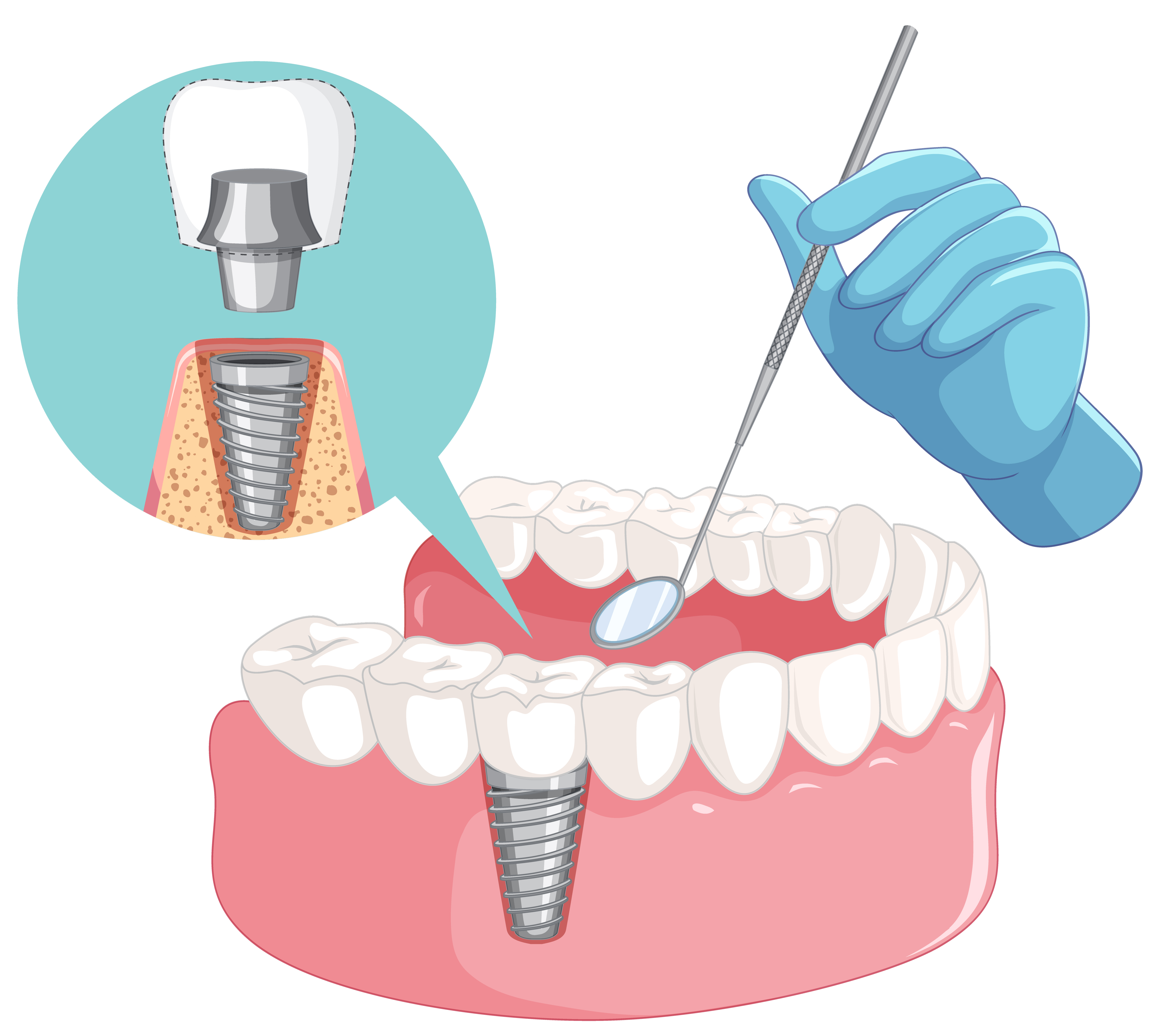 Dental Implants South East London