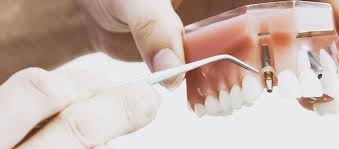 Barrington family dental All-on-Four Dental Implants Treatment Lake Zurich
