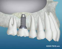 wisdom teeth removal near me dental implants barrington