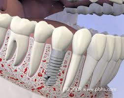 wisdom teeth removal near me dental implants barrington