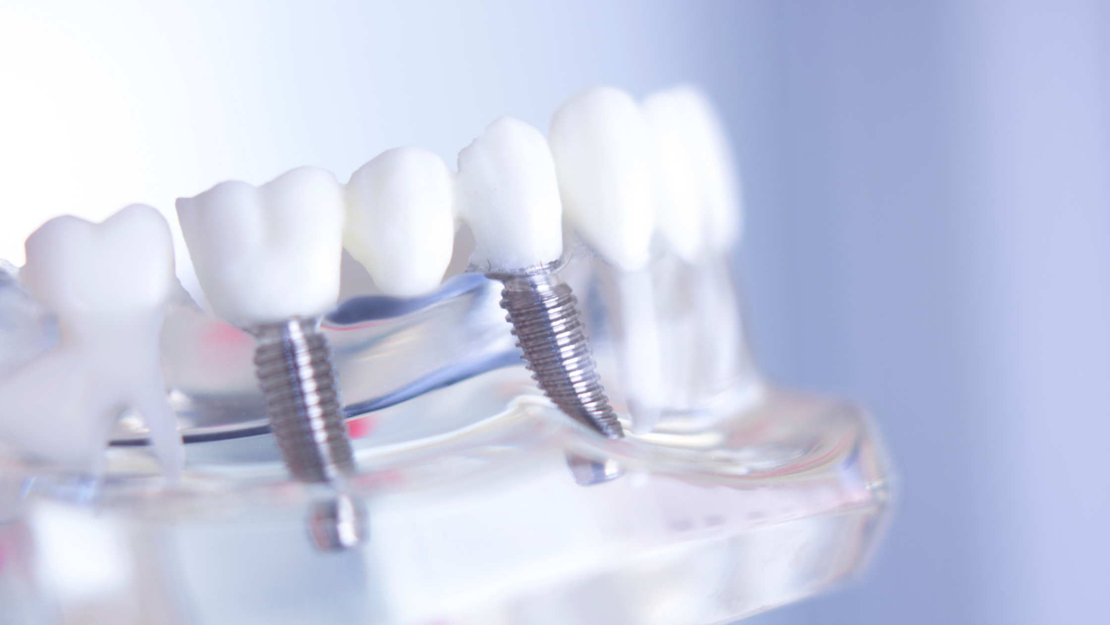 Everything You Need to Know About All-On-X Dental Implants?