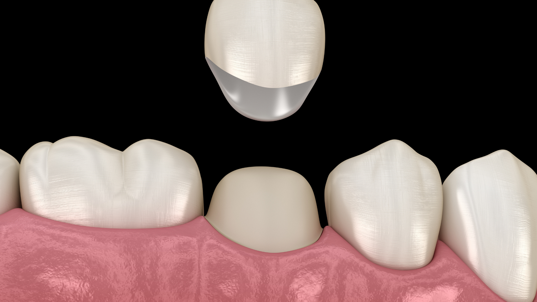 Do You Need Dental Crown After Root Canal Therapy?
