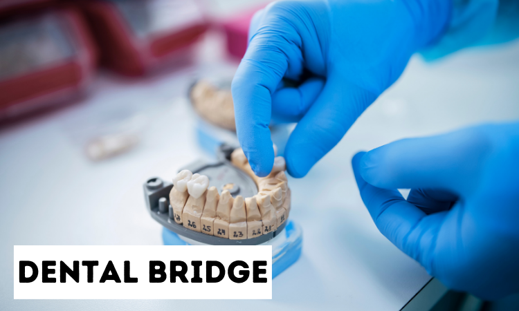 DENTAL BRIDGE PROBLEMS AND HOW TO AVOID THEM?
