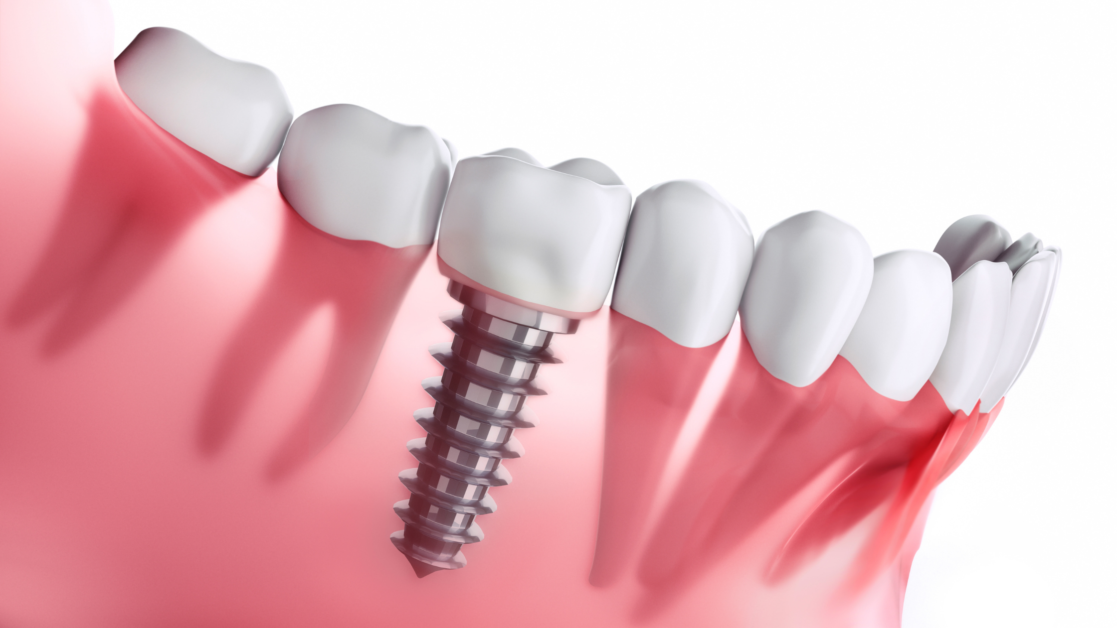 Full Mouth Dental Implants- Types and Procedure
