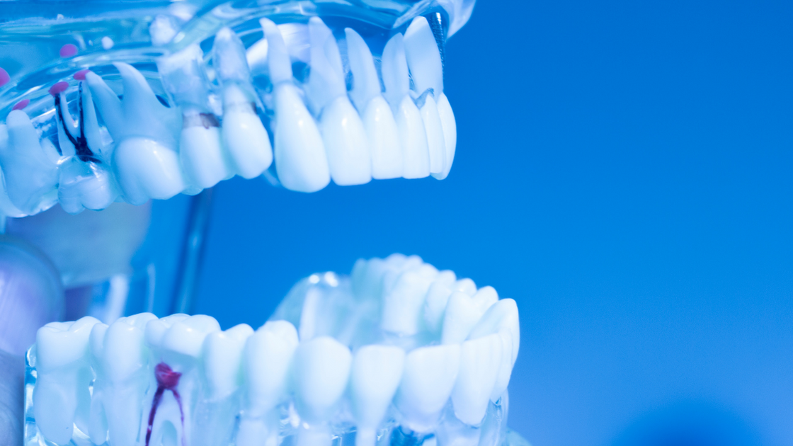What Are the Benefits of Full Mouth Dental Implants?