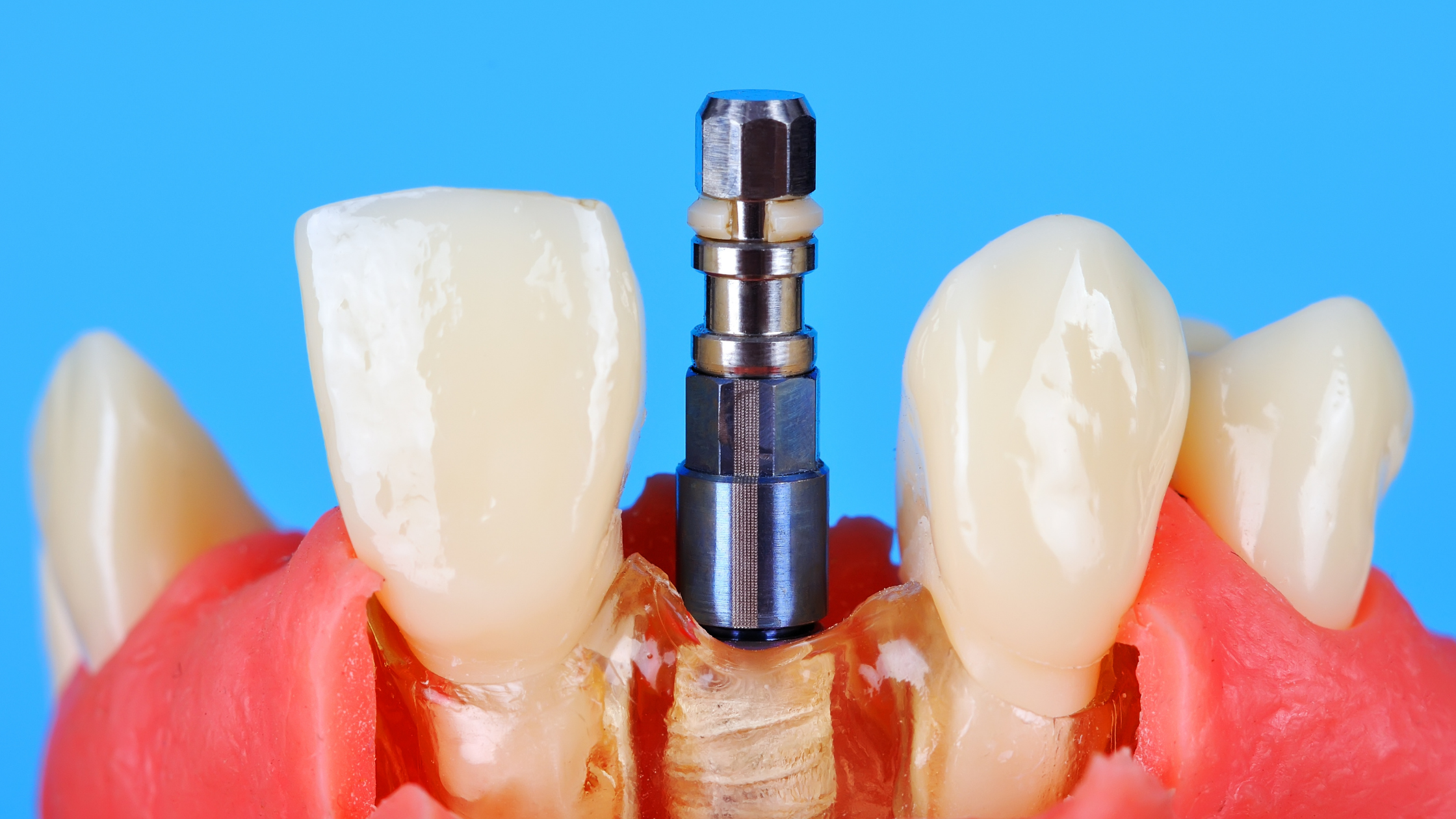  All About Mini Dental Implants: Benefits, Procedure, Care, Recovery