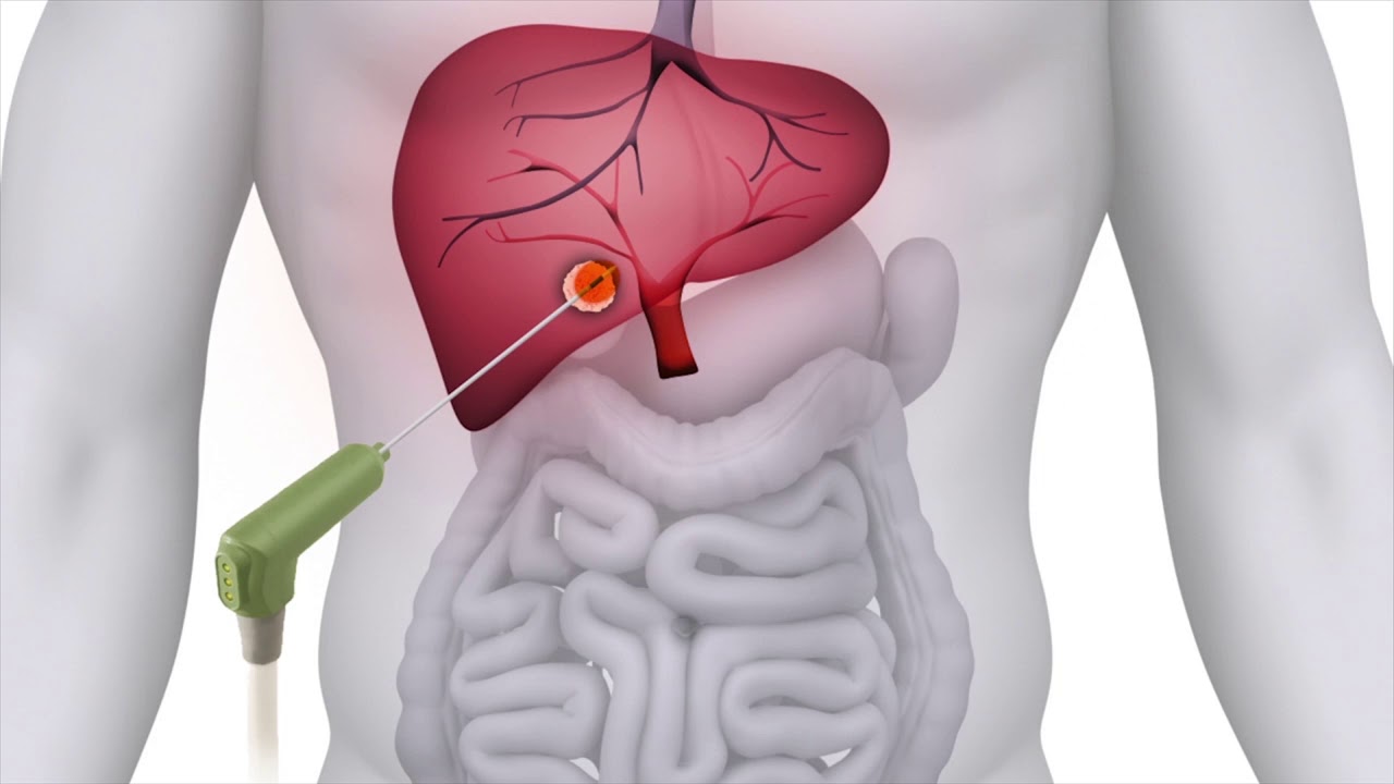 Tumor Ablation Market Development, Trends, Application and Forecast to 2030