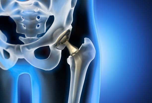 Orthopedic Implants Market Key Facts and Forecast Predictions Presented 2022-2030