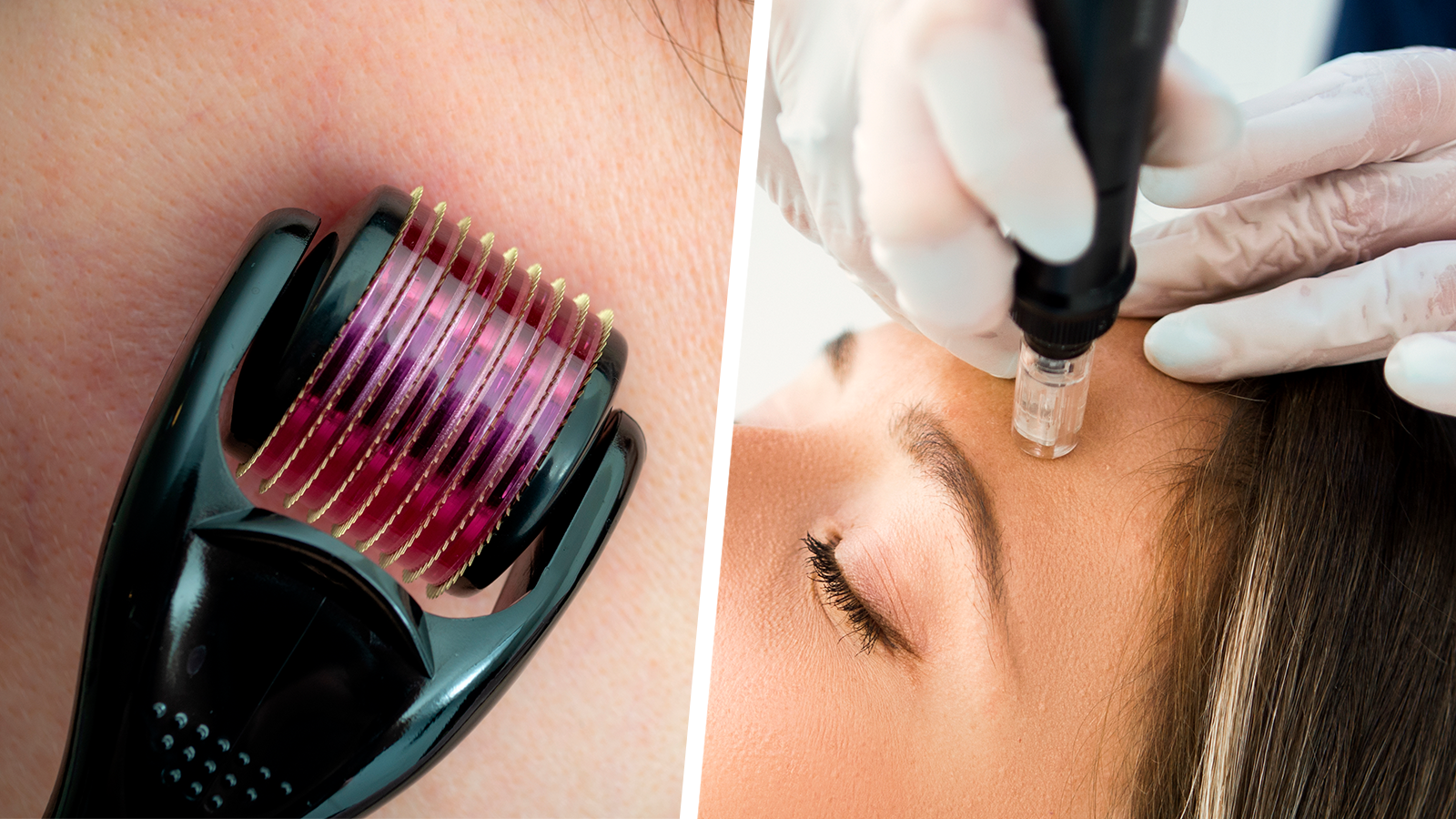 Get to Know How Microneedling Works for Your Skin