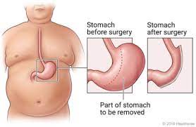 Everything You Need to Know About Gastric Sleeve Surgery: The Complete Procedure.