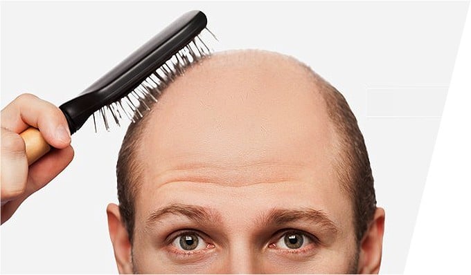 Alopecia areata 
