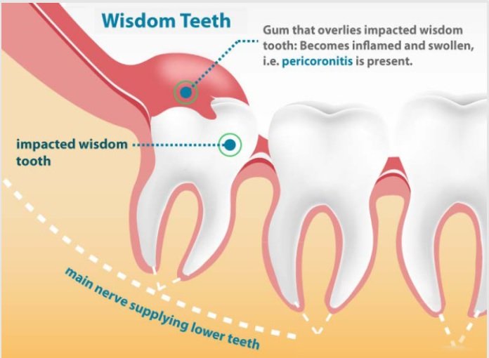 how to get rid of wisdom tooth pain