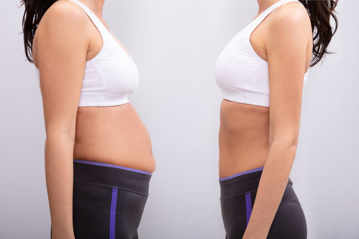 Post-Tummy Tuck Frequently Asked Questions