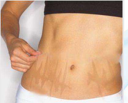 Stretch Mark Treatment - Biological Technique