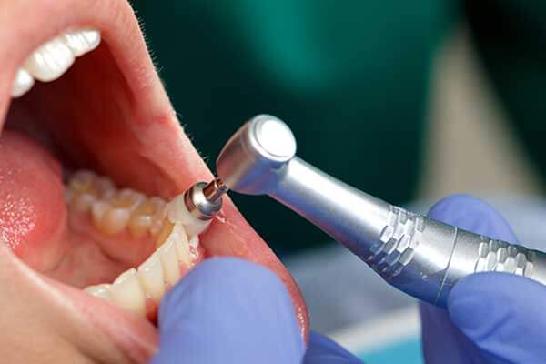 	 Restoration And Oral Prophylaxis- Mb Chen Dental Clinic 