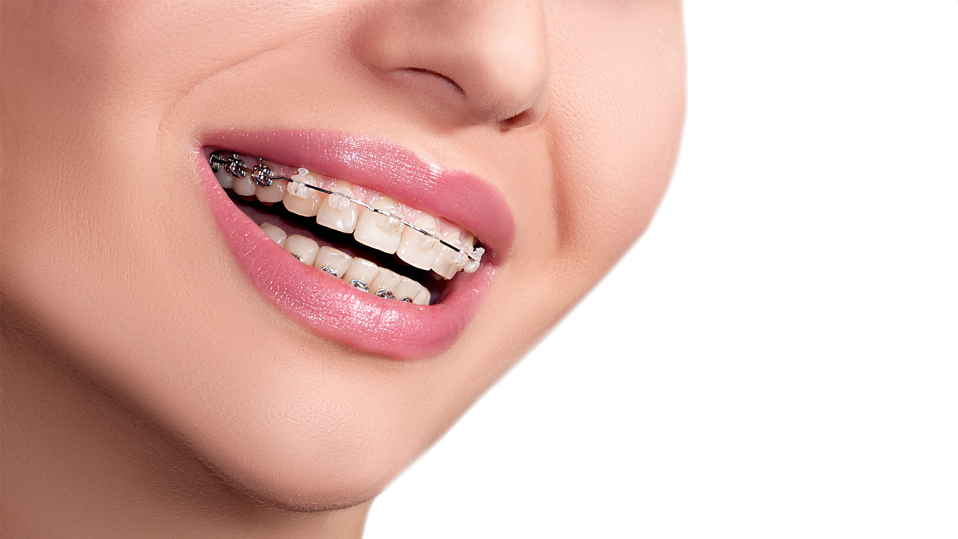 Lingual braces - An Excellent Solution For Teeth Straightening