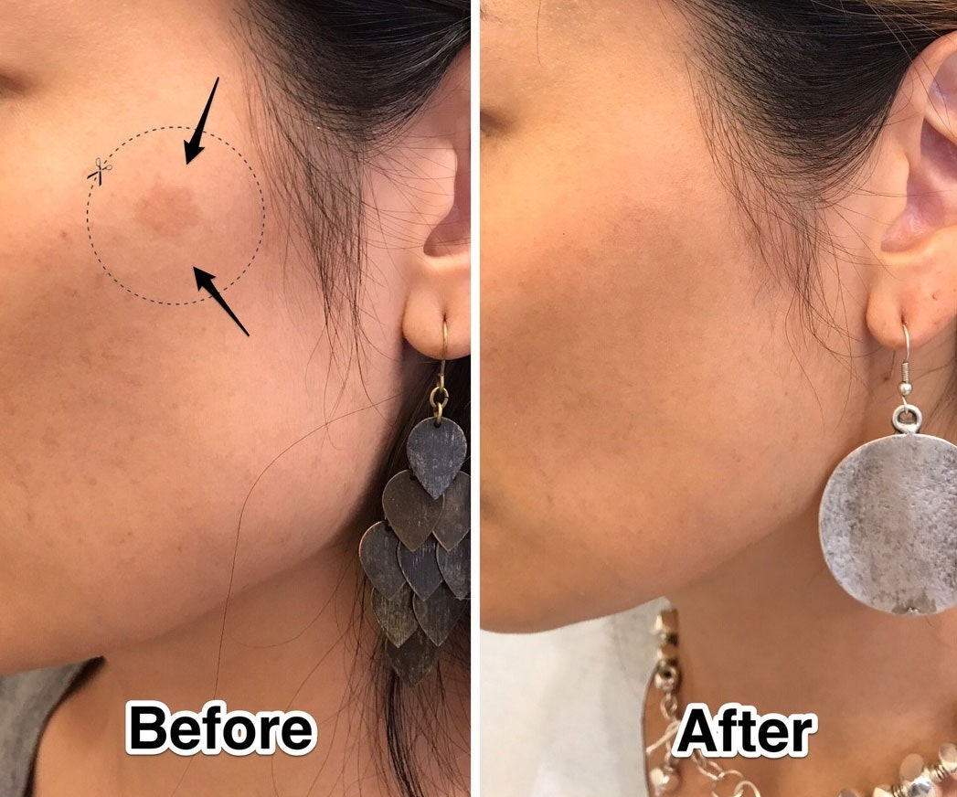 Benefits of Skin Resurfacing Treatment